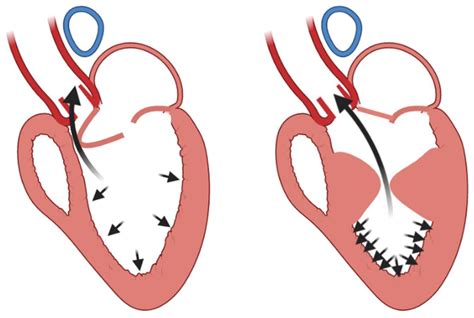 lv aneurysm sheme